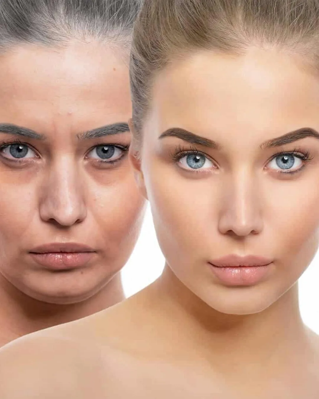 PRP (Platelet Rich Plasma)