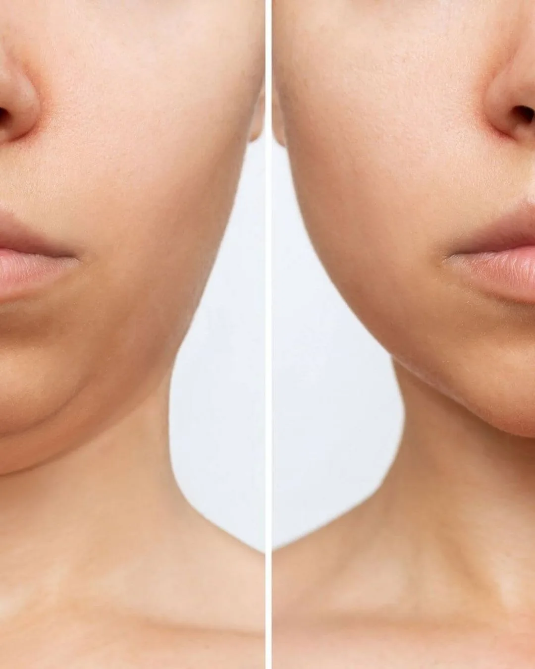 Endolift